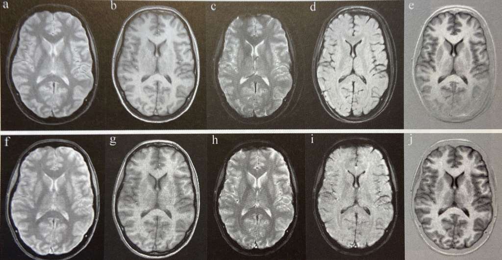 生存している患者に対するsynthetic MRIスキャンの結果の例